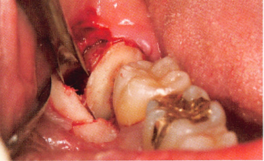 用这种药,拔牙要小心?