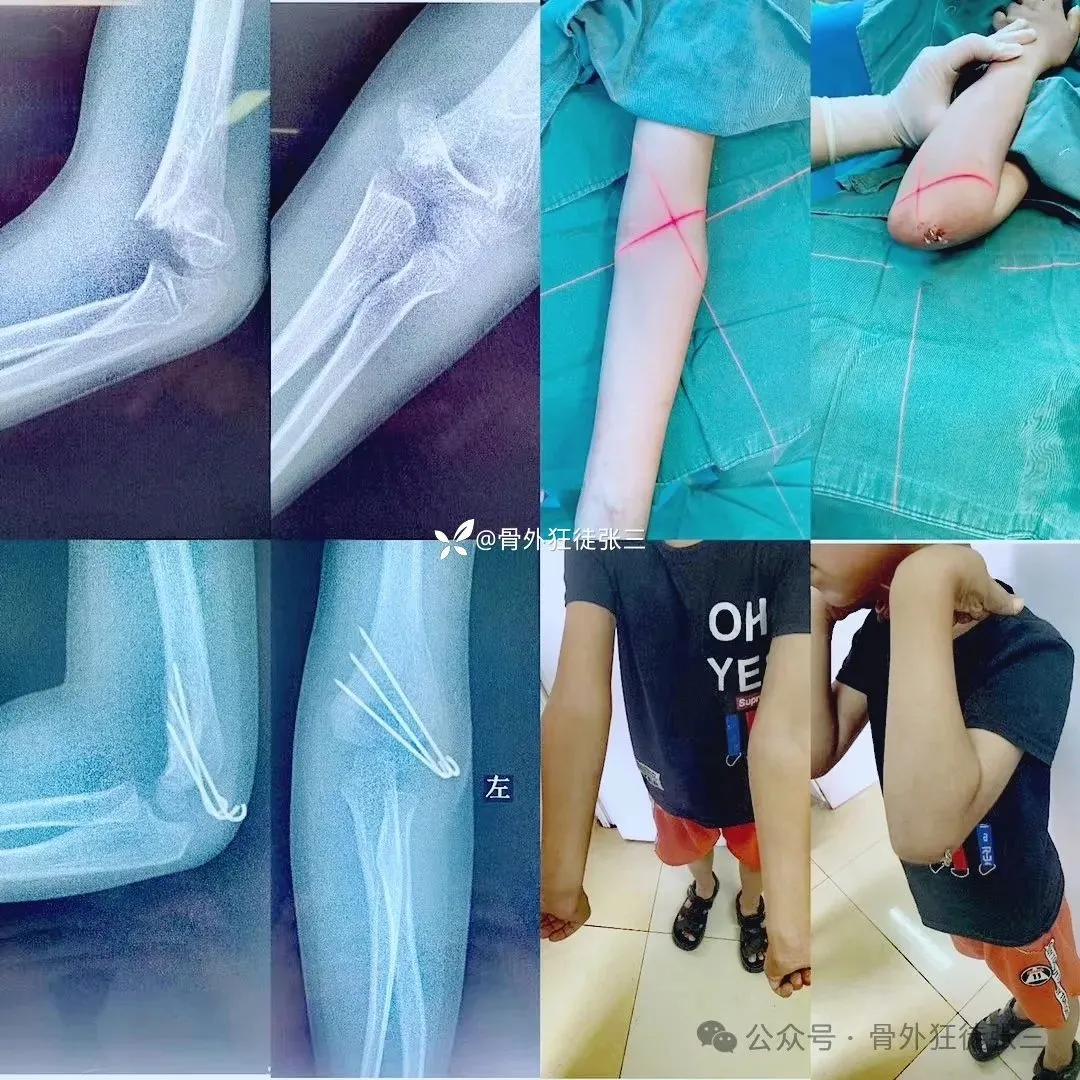 儿童髁上骨折“零切开”合集