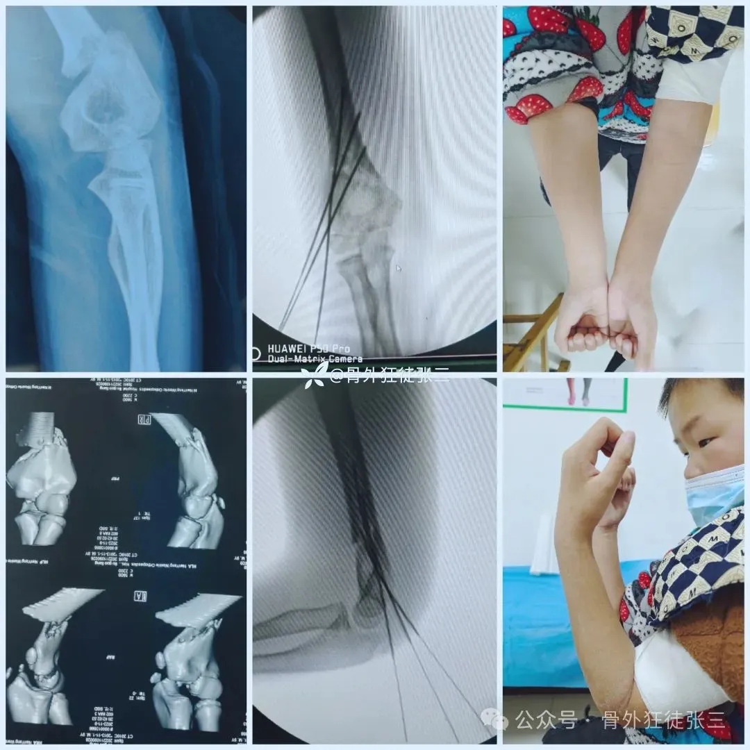 儿童髁上骨折“零切开”合集