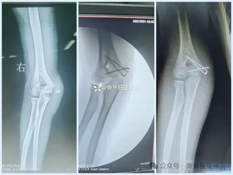 儿童髁上骨折“零切开”合集