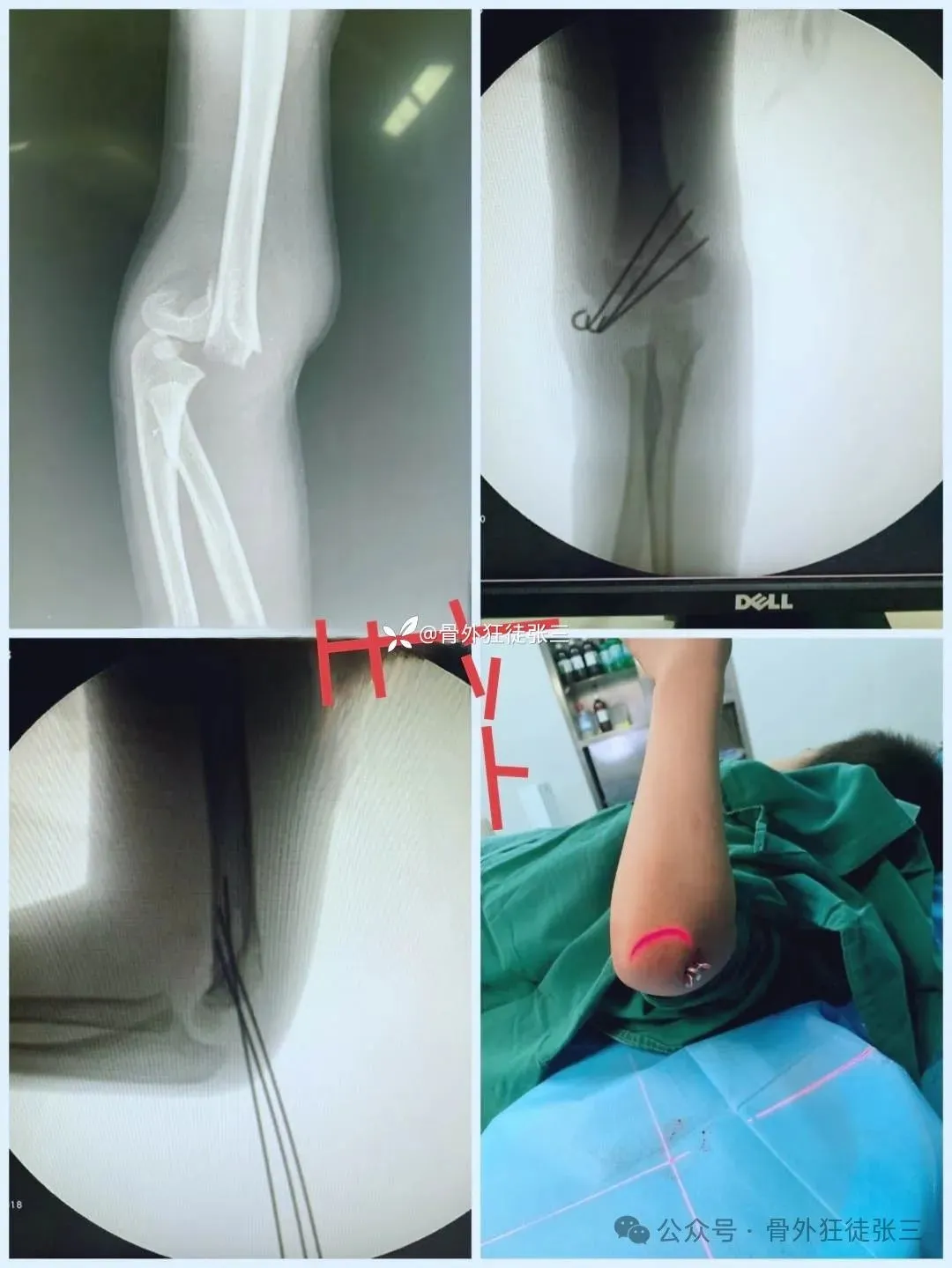 儿童髁上骨折“零切开”合集