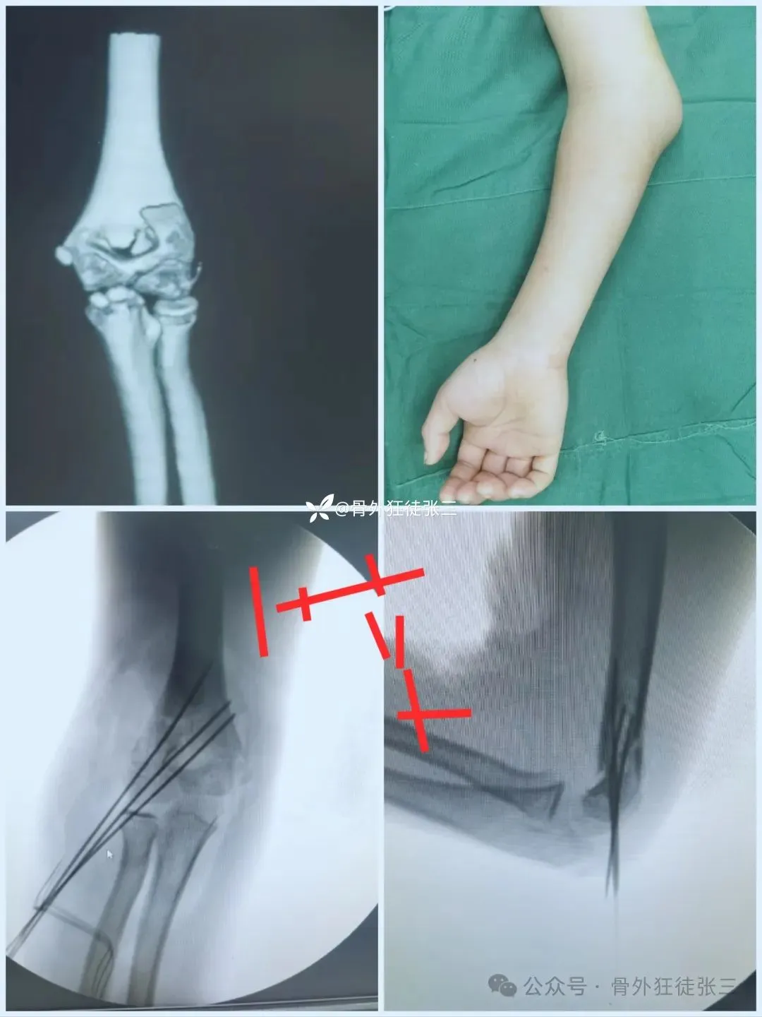 儿童髁上骨折“零切开”合集