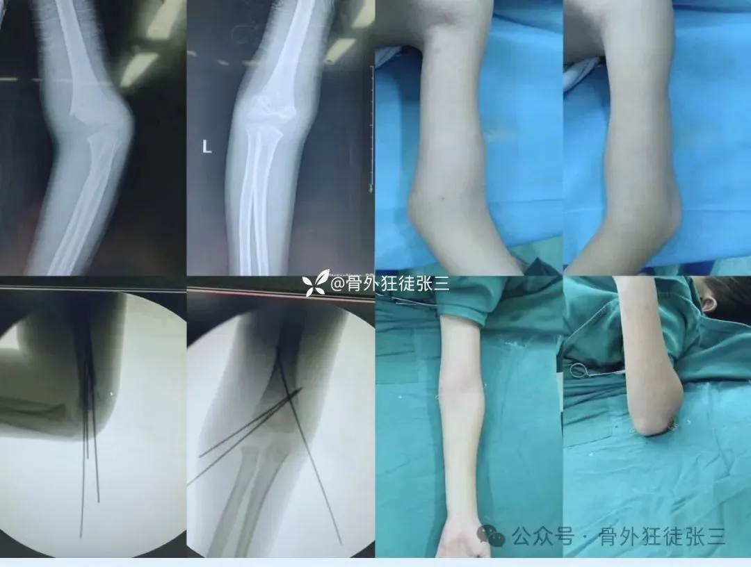 儿童髁上骨折“零切开”合集