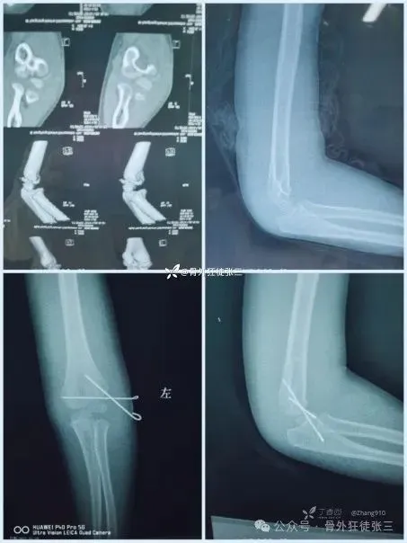 儿童髁上骨折“零切开”合集