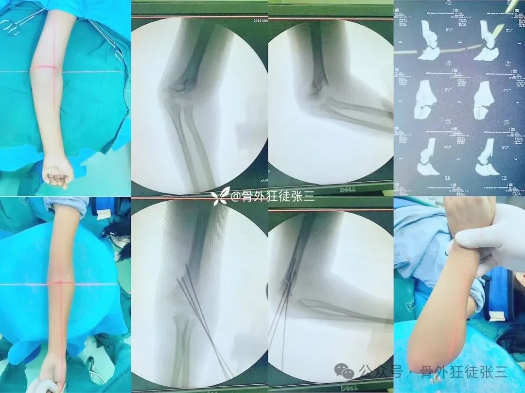 儿童髁上骨折“零切开”合集