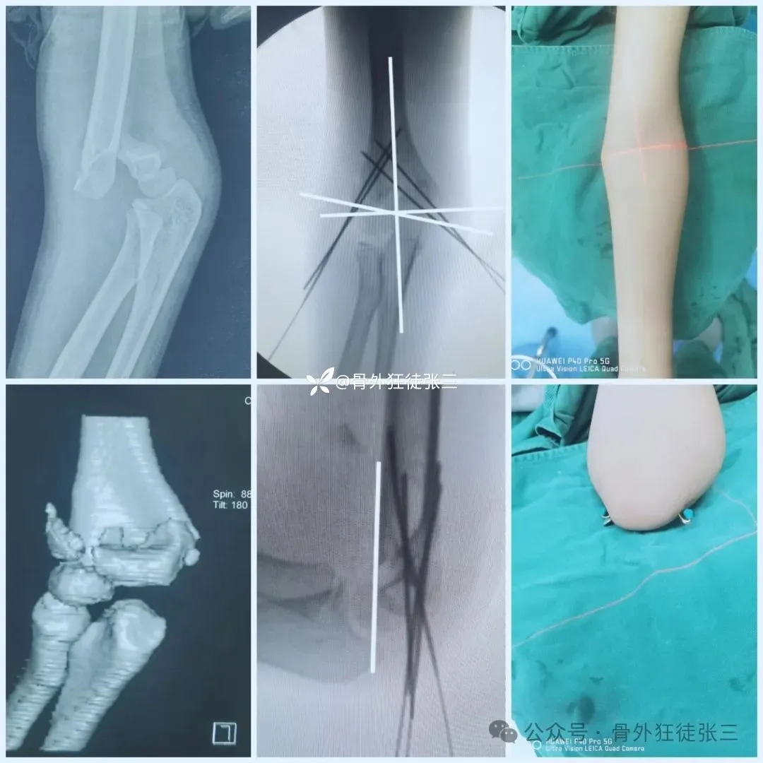 儿童髁上骨折“零切开”合集