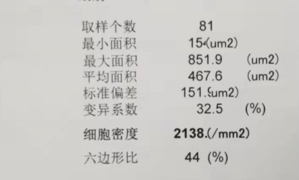 白内障术后的意外插曲：角膜水肿之扰