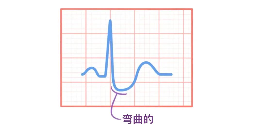 心电图原来可以这样看：省心！