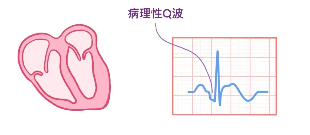 心电图原来可以这样看：省心！