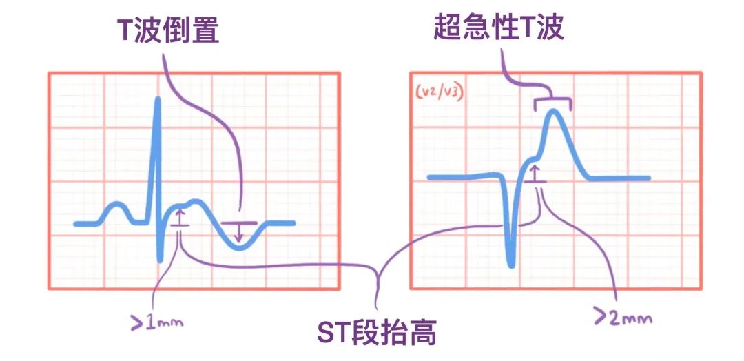 心电图原来可以这样看：省心！