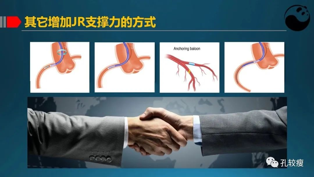 指引导管的选择和操作