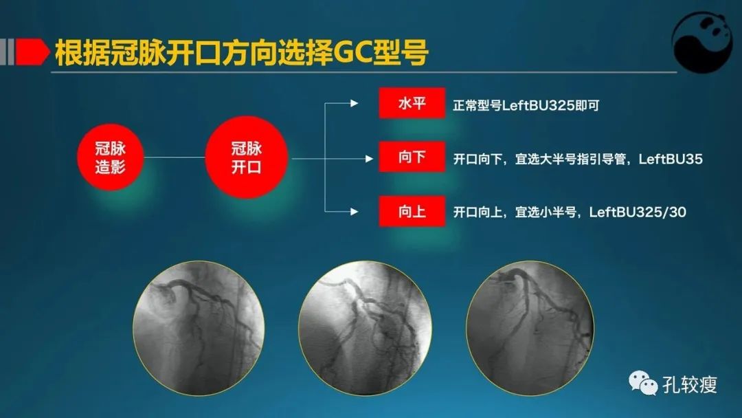 指引导管的选择和操作