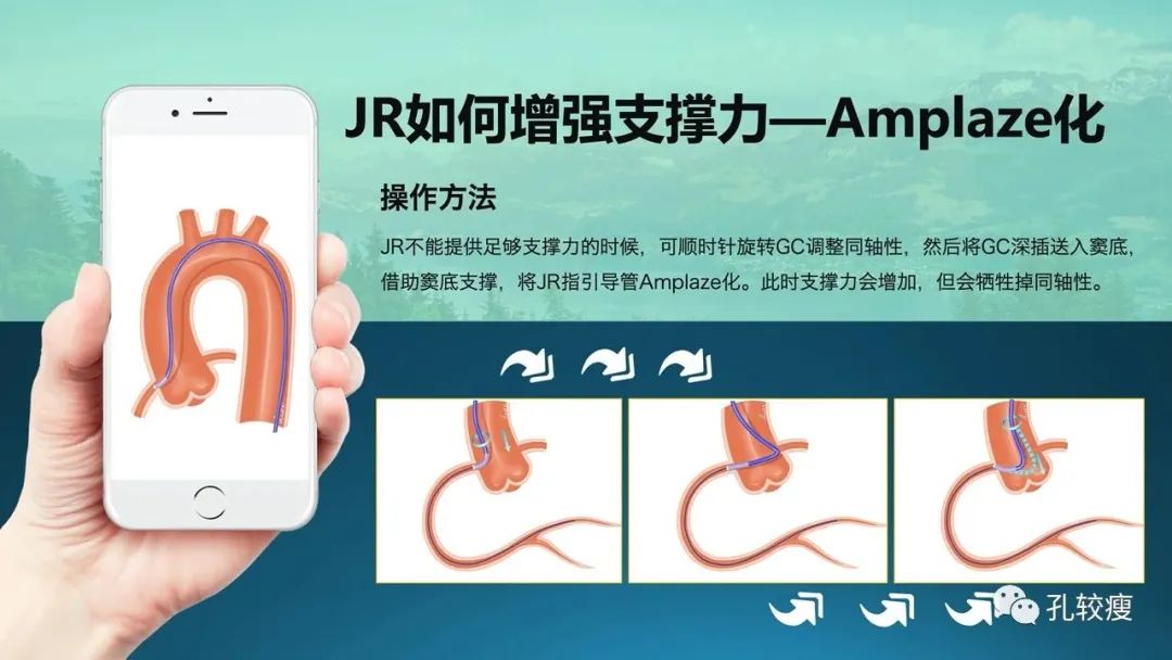 指引导管的选择和操作