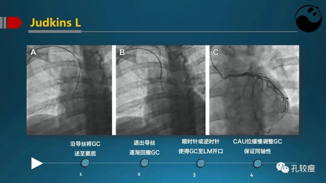 指引导管的选择和操作