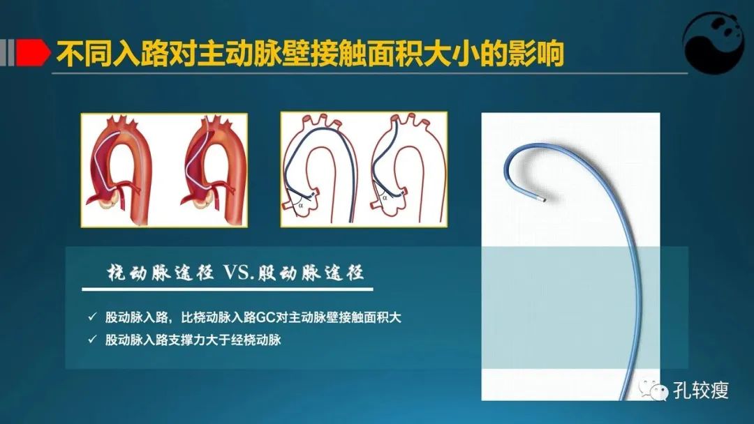 指引导管的选择和操作