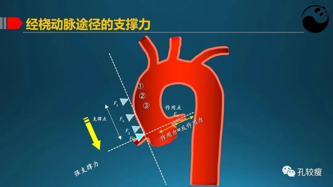 指引导管的选择和操作