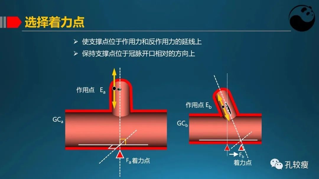 指引导管的选择和操作