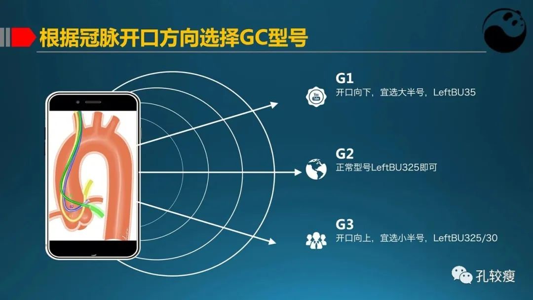 指引导管的选择和操作