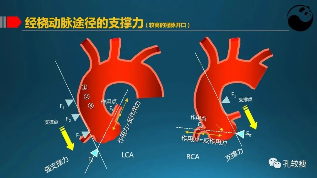 指引导管的选择和操作