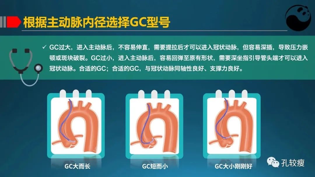指引导管的选择和操作