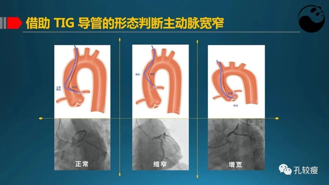 指引导管的选择和操作