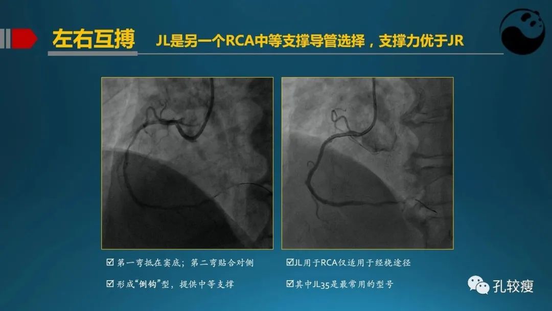 指引导管的选择和操作