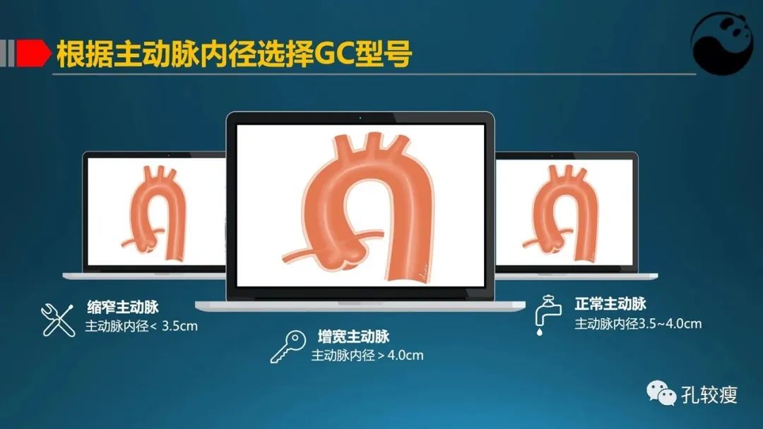 指引导管的选择和操作