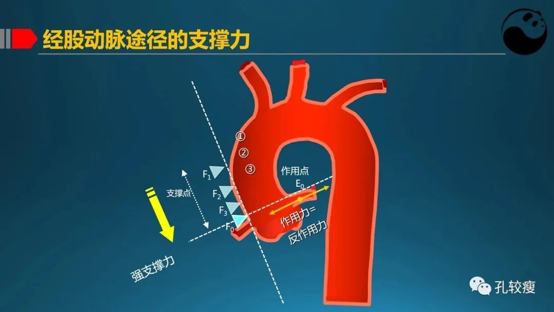 指引导管的选择和操作