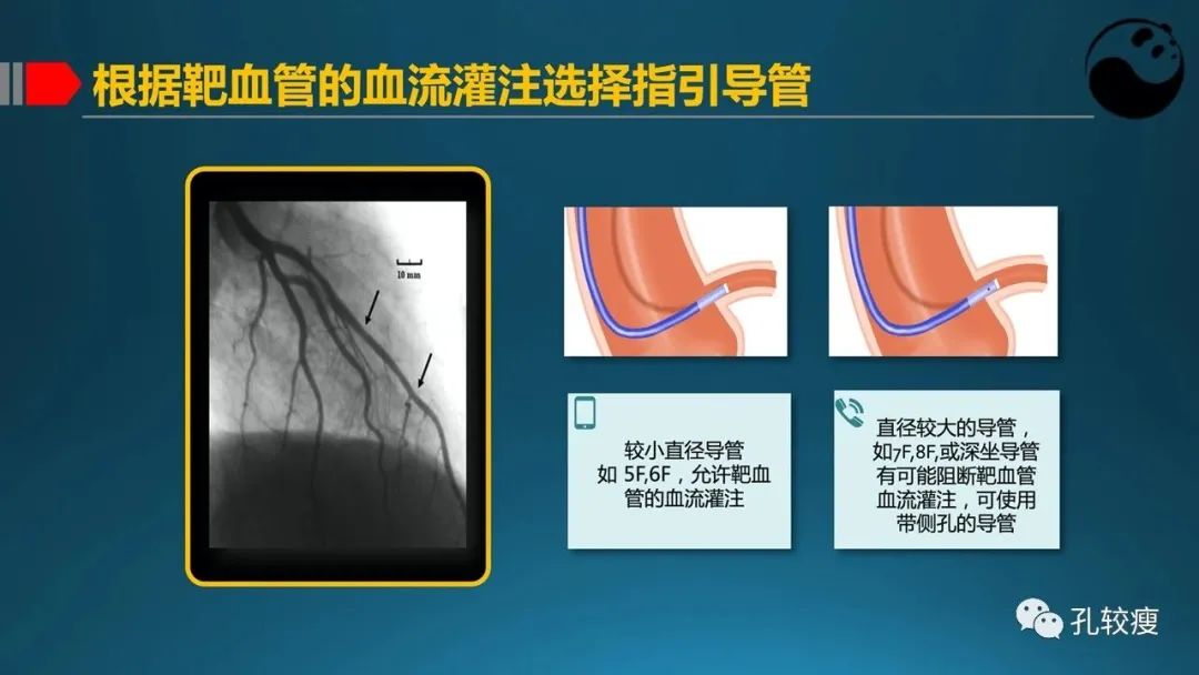 指引导管的选择和操作