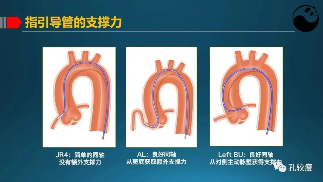 指引导管的选择和操作