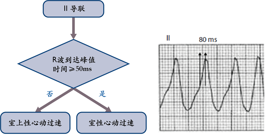 这3种病，都表现为『宽QRS波心动过速』！