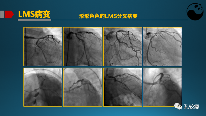 为什么说左主干是一个特殊的分叉