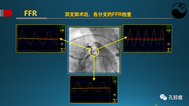 为什么说左主干是一个特殊的分叉