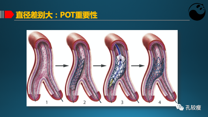 为什么说左主干是一个特殊的分叉