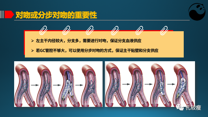 为什么说左主干是一个特殊的分叉