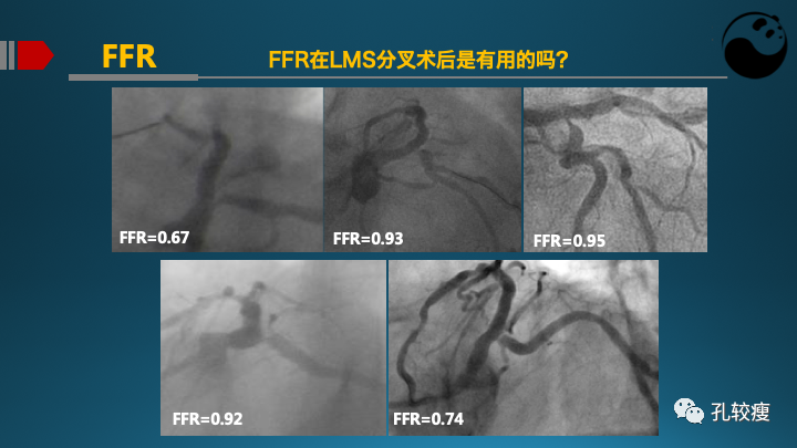 为什么说左主干是一个特殊的分叉