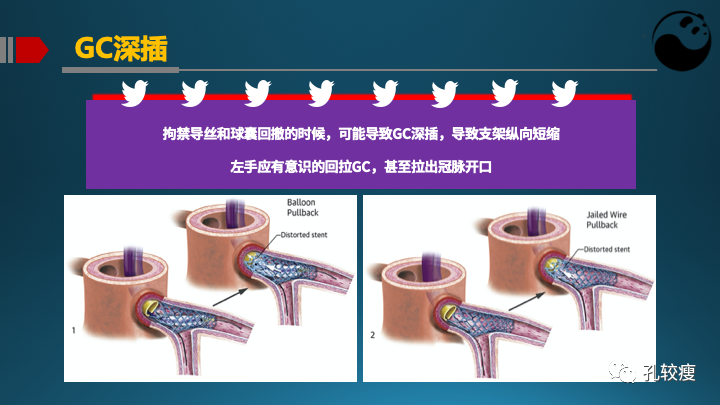 为什么说左主干是一个特殊的分叉