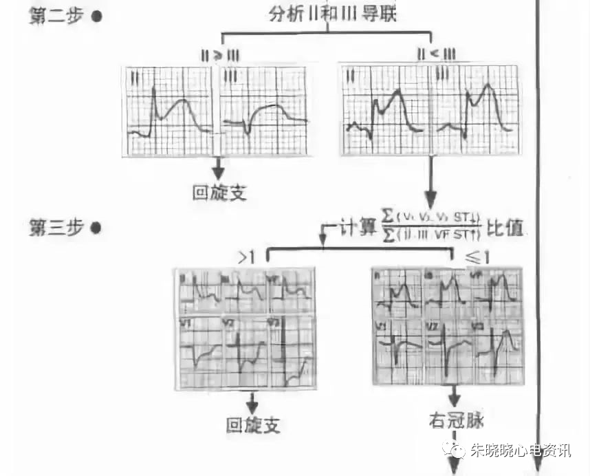 心梗时快速判断梗死部位和范围！