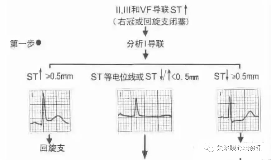 心梗时快速判断梗死部位和范围！
