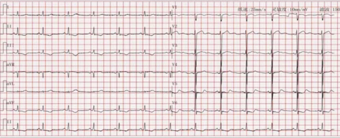 从一个病例学习心肌淀粉样变的临床诊疗策略