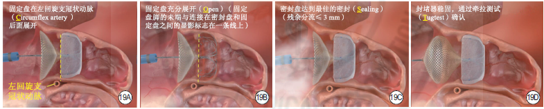 抗凝治疗受限？出血风险高？这份LAAC共识为房颤患者打开“安全通道”！