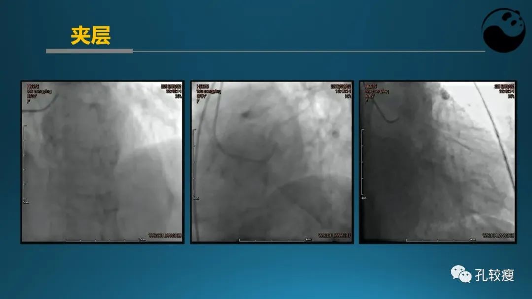 从零开始,掌握冠脉造影读片要领