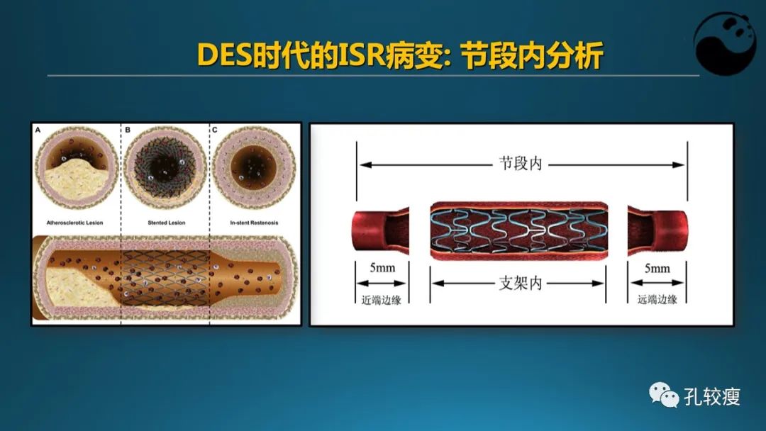 从零开始,掌握冠脉造影读片要领