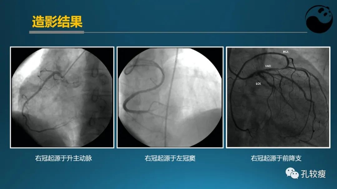 从零开始,掌握冠脉造影读片要领