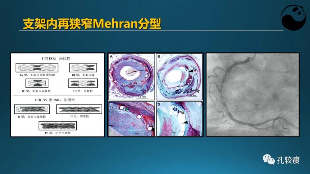 从零开始,掌握冠脉造影读片要领