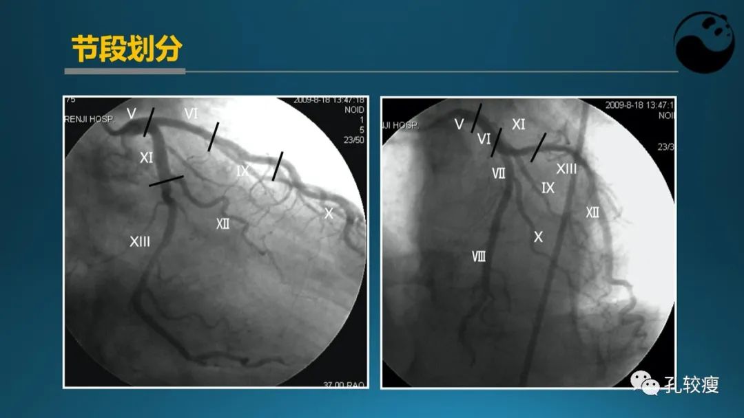 从零开始,掌握冠脉造影读片要领