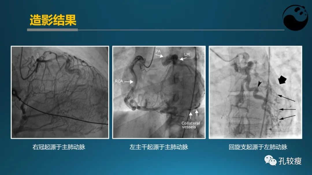 从零开始,掌握冠脉造影读片要领
