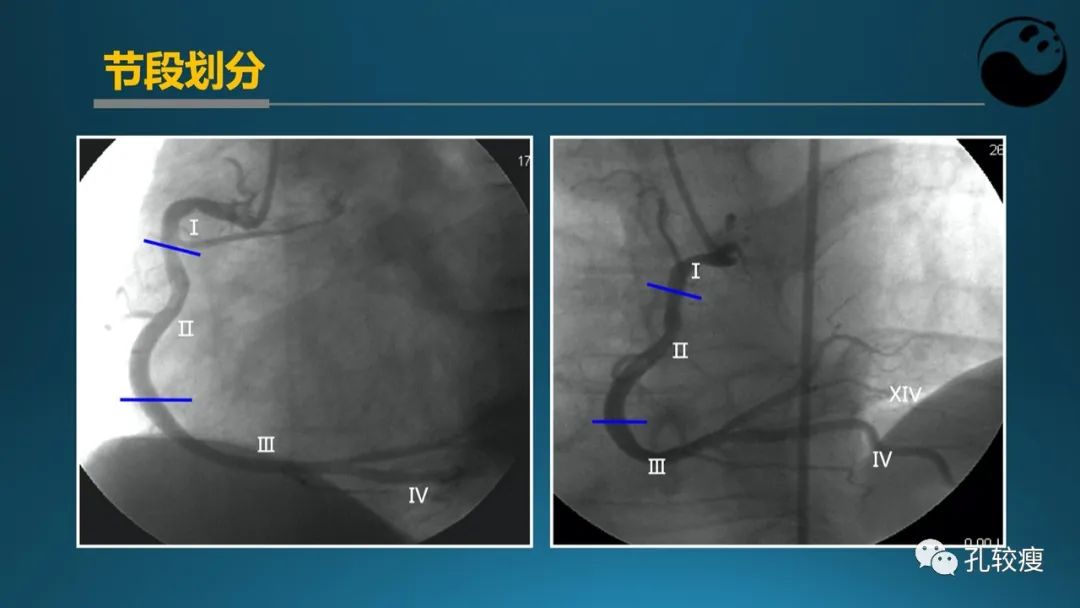 从零开始,掌握冠脉造影读片要领