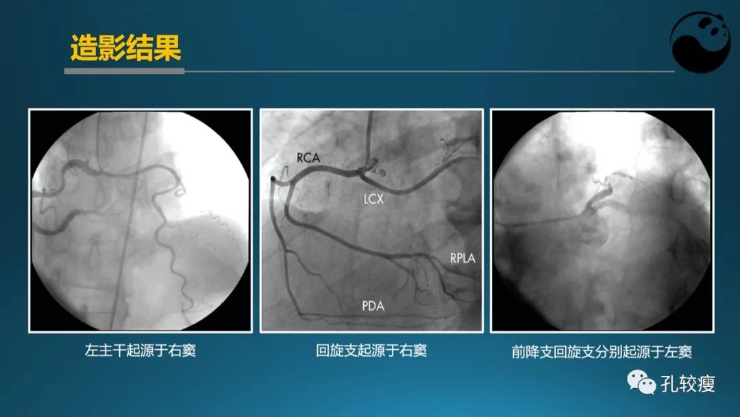 从零开始,掌握冠脉造影读片要领