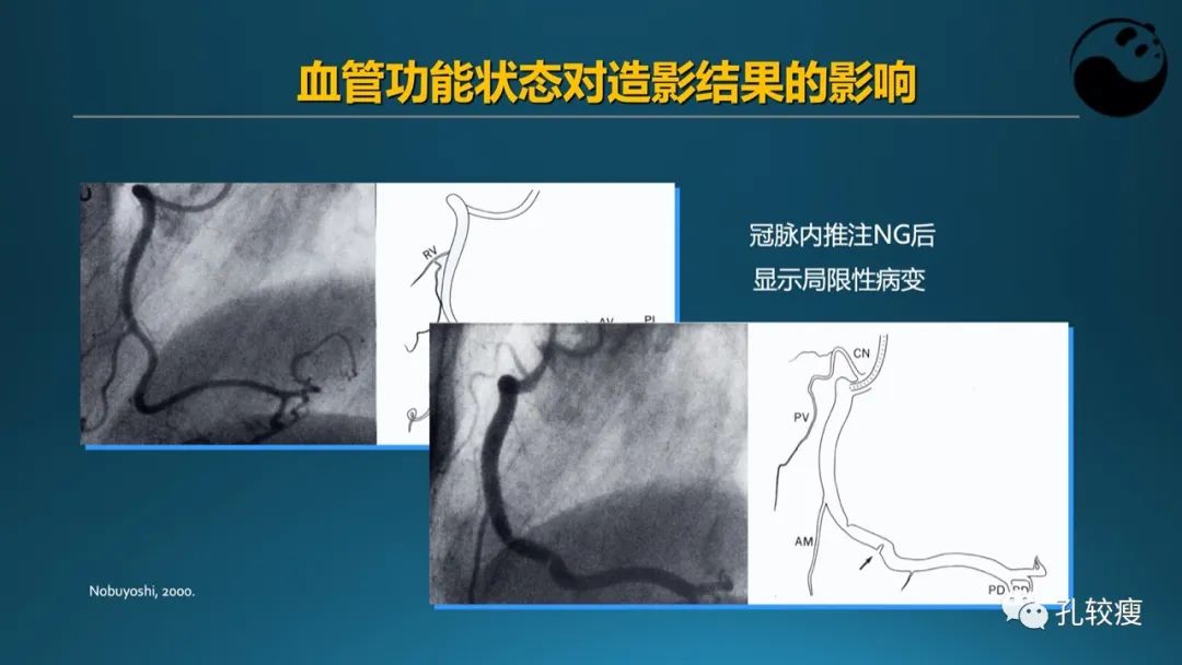 从零开始,掌握冠脉造影读片要领